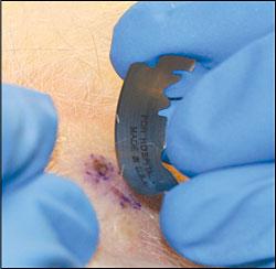 Golden Plains Skin Cancer Clinic - A Shave Biopsy