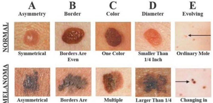 Full Body Skin Examination