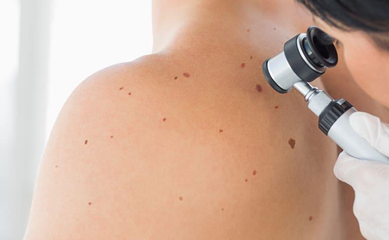 Full Body Skin Examination