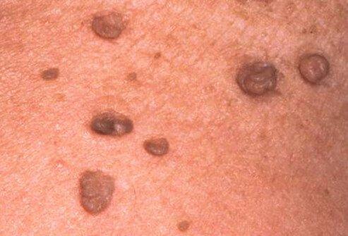 Golden Plains Skin Cancer Clinic - Skin Tag Removal