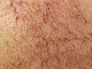 Rosacea Treatment - Before